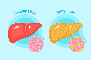 7 Foods for Fatty Liver: A Guide to Enhancing Liver Health